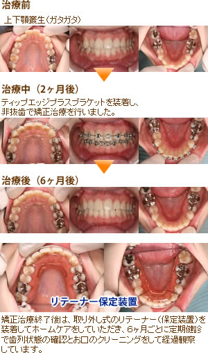 中学生からの矯正 | にしお歯科