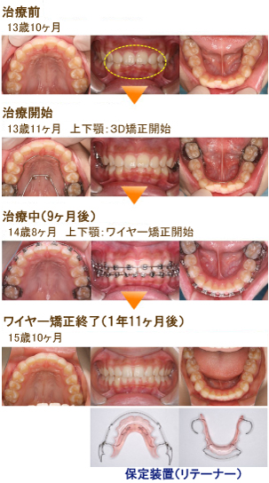 中学生からの矯正 | にしお歯科