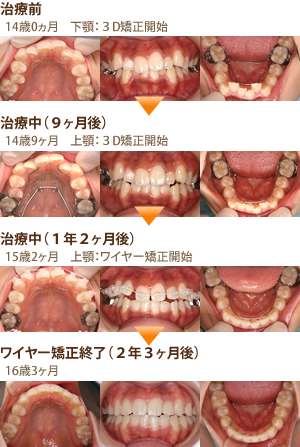 中学生からの矯正 | にしお歯科