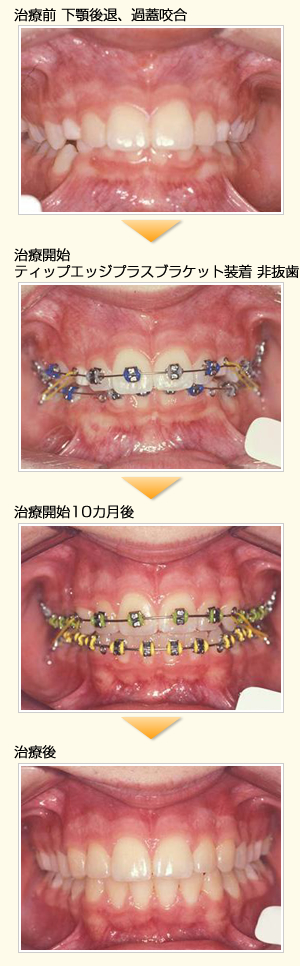 中学生からの矯正 | にしお歯科
