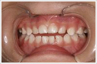 指しゃぶりによる開口状態