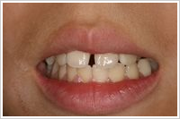 上下顎に３Dを装着した状態