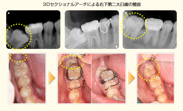 ３Dセクショナルアーチ