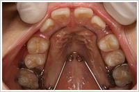 上顎に３DQHを装着