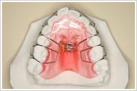 上顎床矯正装置