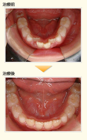 床矯正後にワイヤー矯正