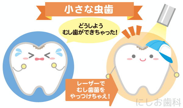 小さなむし歯 小さなむし歯