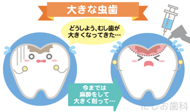 大きなむし歯 大きなむし歯