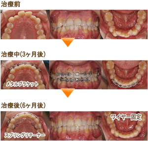 部分矯正・プチ矯正 | にしお歯科