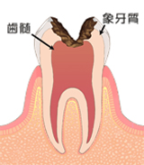歯の神経を抜いてしまうと、歯の寿命は短くなってしまう