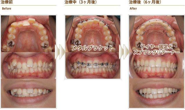 八重歯の代表症例