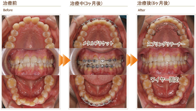 症例4：出っ歯と下の前歯のガタガタが気になる（30代後半男性）