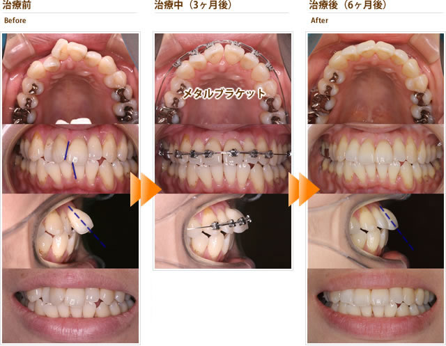 症例7：上の前歯がねじれていて重なっている。口を閉じにくい（30代後半女性）